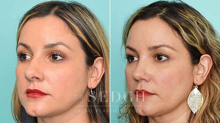 patient before and after rhinoplasty procedure