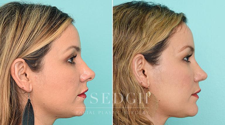 patient before and after rhinoplasty procedure