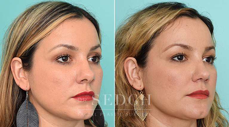 patient before and after rhinoplasty procedure