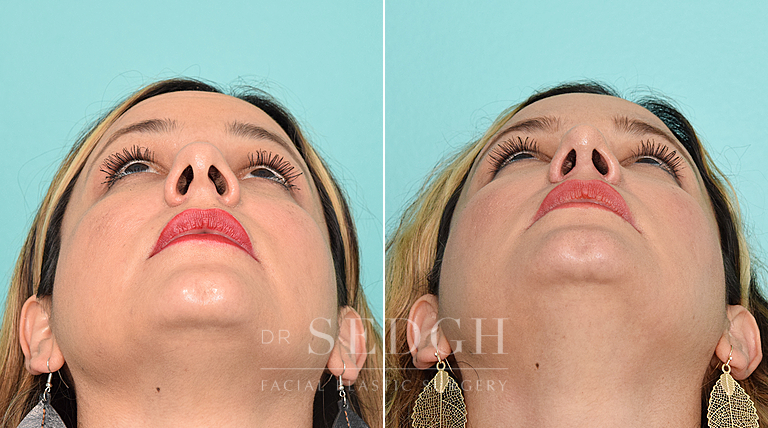 patient before and after rhinoplasty procedure