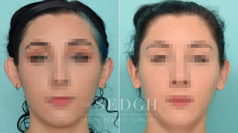 patient before and after otoplasty procedure