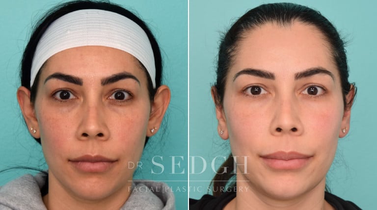 patient before and after otoplasty procedure