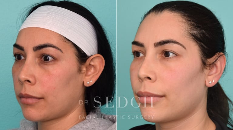 patient before and after otoplasty procedure