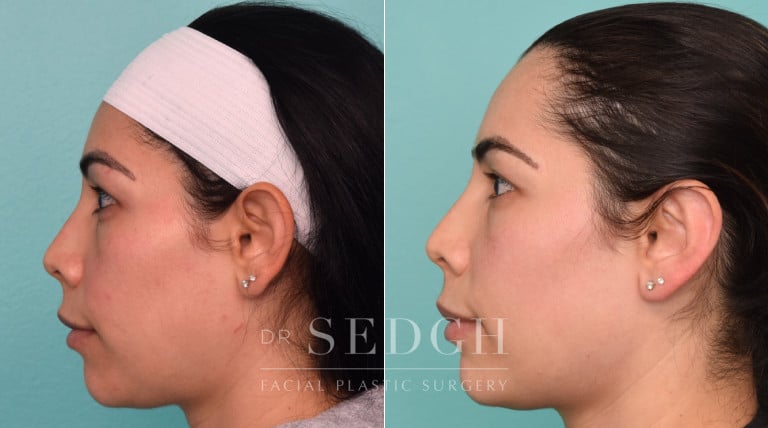 patient before and after otoplasty procedure