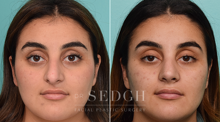 patient before and after rhinoplasty procedure