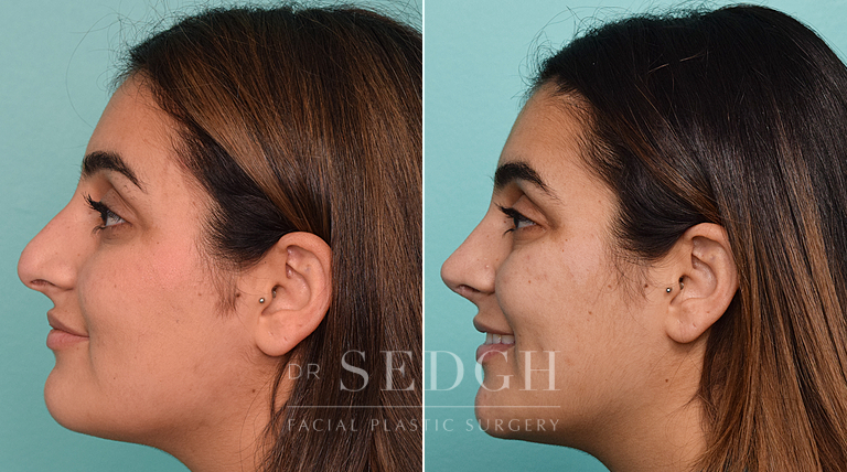 patient before and after rhinoplasty procedure