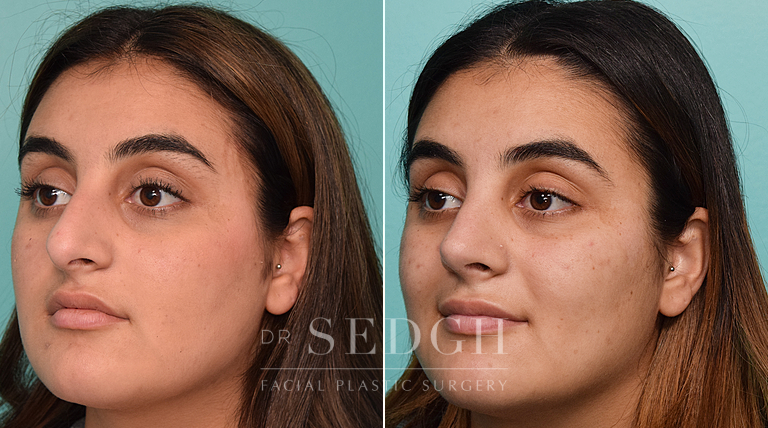 patient before and after rhinoplasty procedure