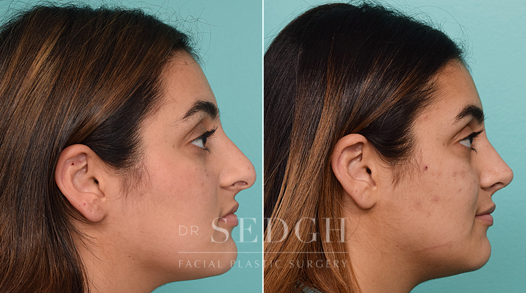 patient before and after rhinoplasty procedure