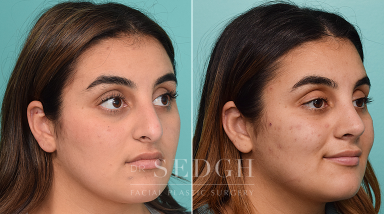 patient before and after rhinoplasty procedure