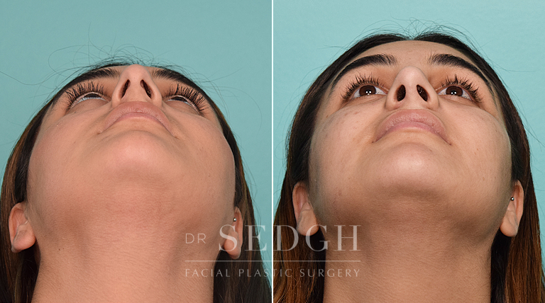 patient before and after rhinoplasty procedure