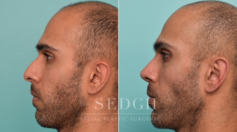 patient before and after rhinoplasty procedure