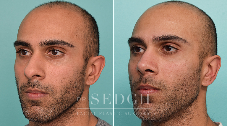 patient before and after rhinoplasty procedure