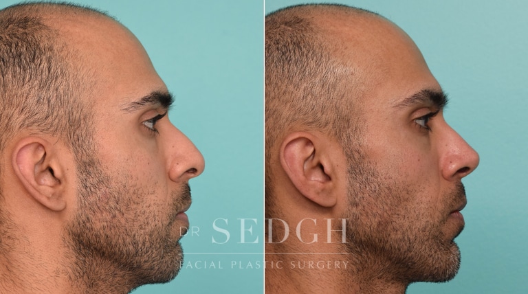 patient before and after rhinoplasty procedure