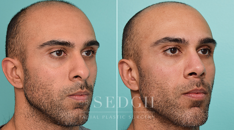 patient before and after rhinoplasty procedure