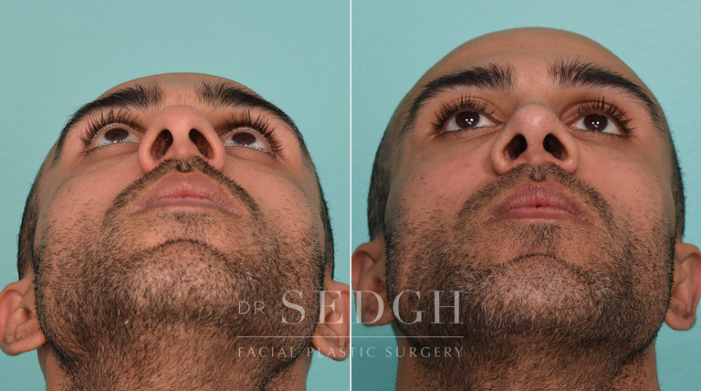 patient before and after rhinoplasty procedure