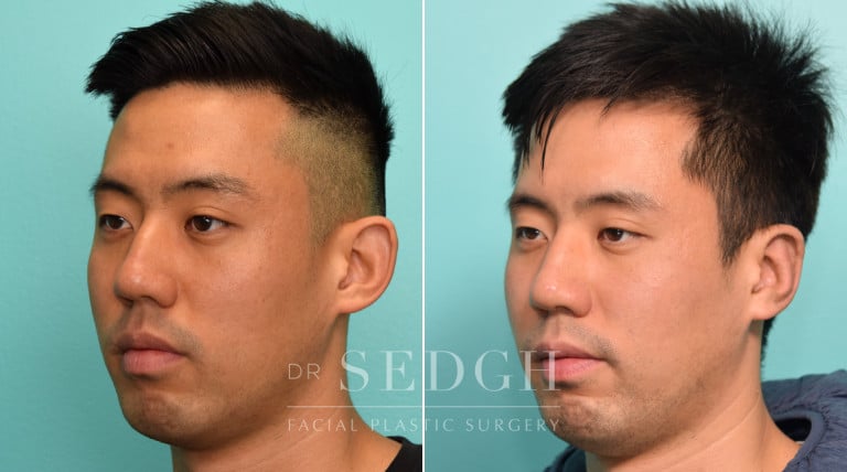 patient before and after otoplasty procedure