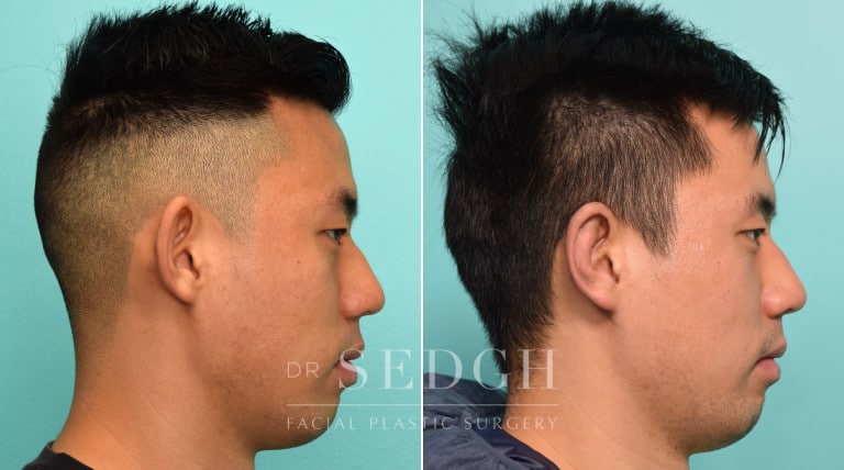 patient before and after otoplasty procedure