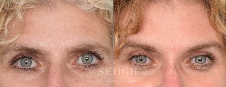 female patient before and after brow lift procedure