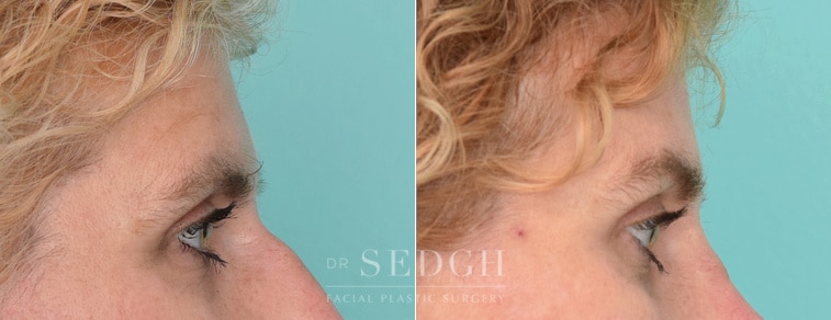 female patient before and after brow lift procedure