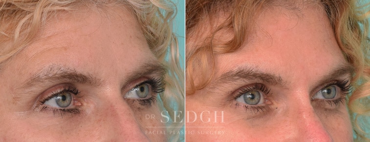 female patient before and after brow lift procedure