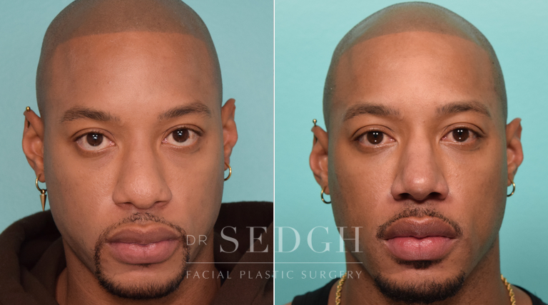 patient before and after rhinoplasty procedure