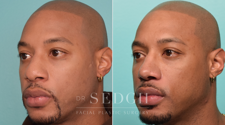 patient before and after rhinoplasty procedure