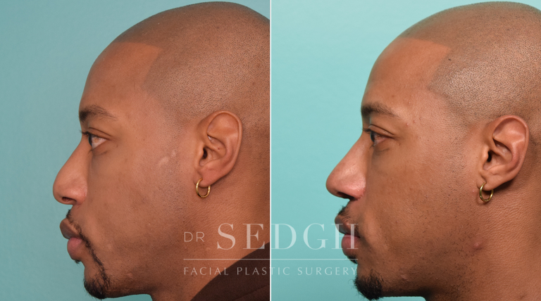 patient before and after rhinoplasty procedure