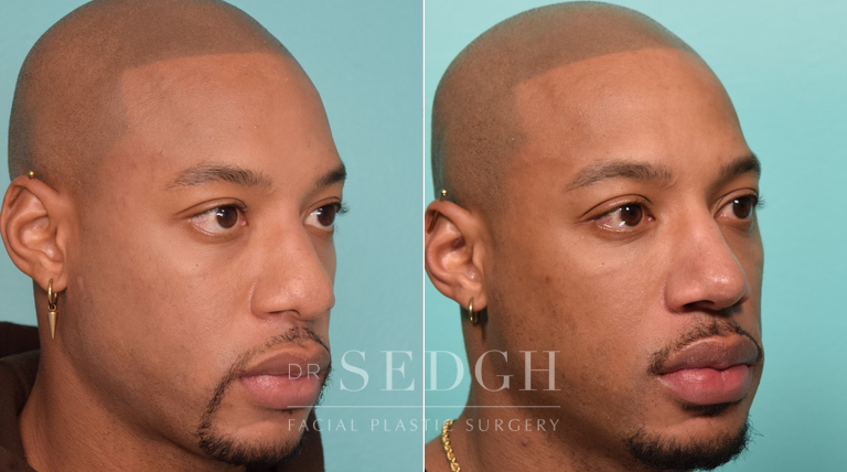 patient before and after rhinoplasty procedure