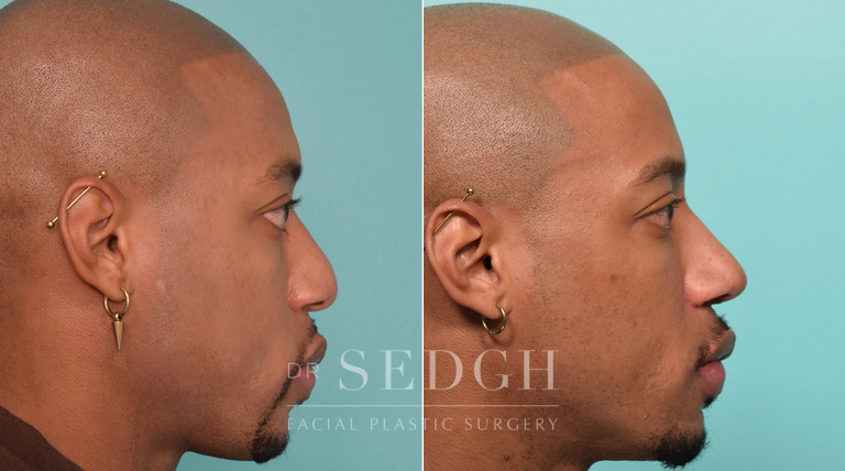 patient before and after rhinoplasty procedure