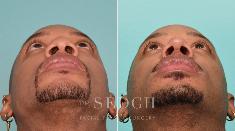 patient before and after rhinoplasty procedure