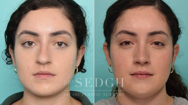 Female Patient Before and After Rhinoplasty | Sedgh