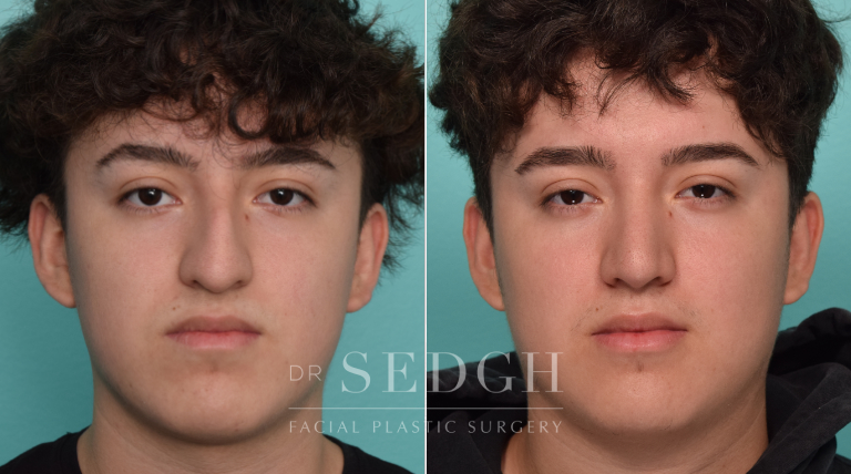 Male Patient Before and After Rhinoplasty | Sedgh