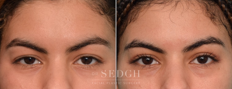 Female Patient Before and After Blepharoplasty | Sedgh
