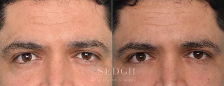 Male Patient Before and After Lower Blepharoplasty | Sedgh