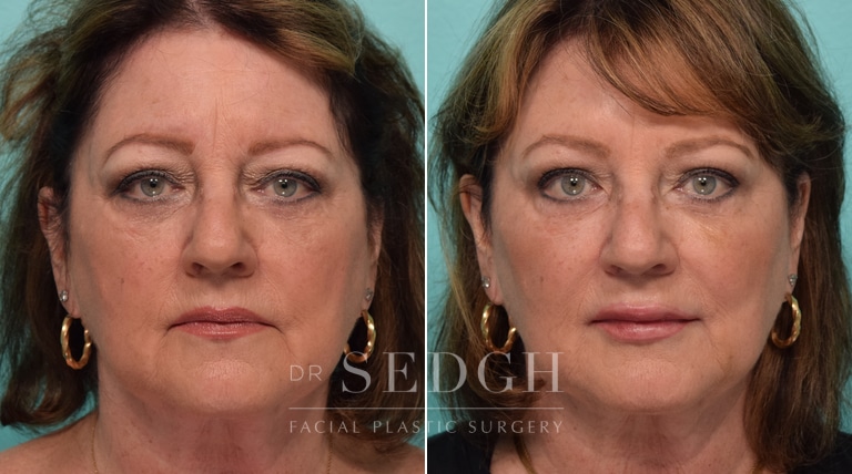 Female Patient Before and After Filler & Botox | Sedgh
