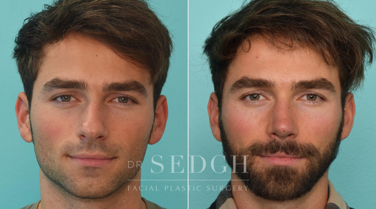 patient before and after rhinoplasty procedure