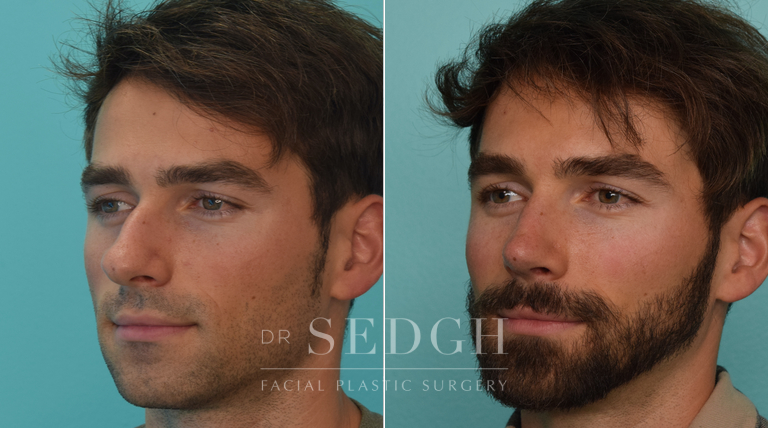 patient before and after rhinoplasty procedure