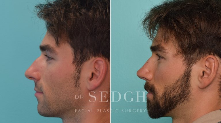 patient before and after rhinoplasty procedure