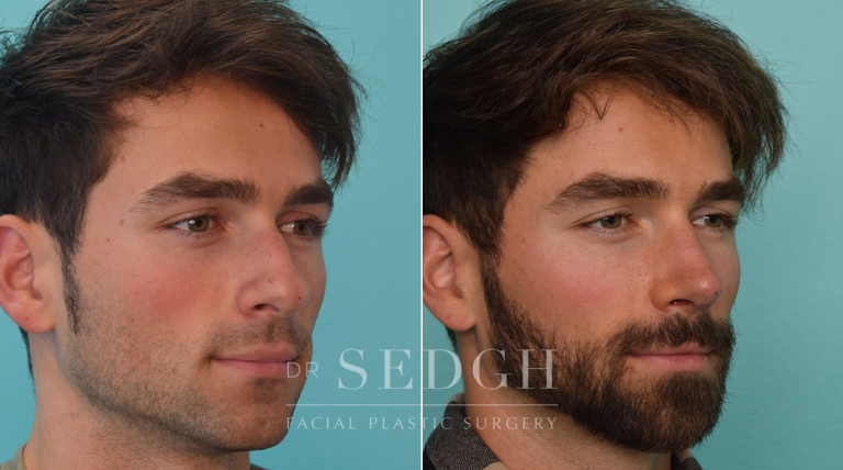 patient before and after rhinoplasty procedure