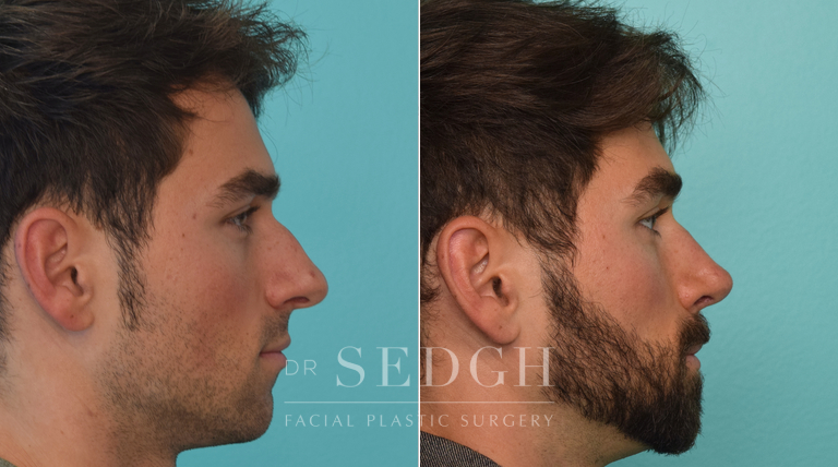 patient before and after rhinoplasty procedure