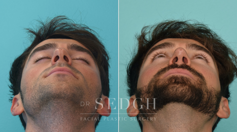 patient before and after rhinoplasty procedure