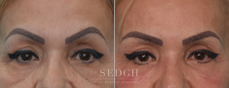 Lower Blepharoplasty Before and After | Sedgh