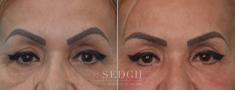 Lower Blepharoplasty Before and After | Sedgh