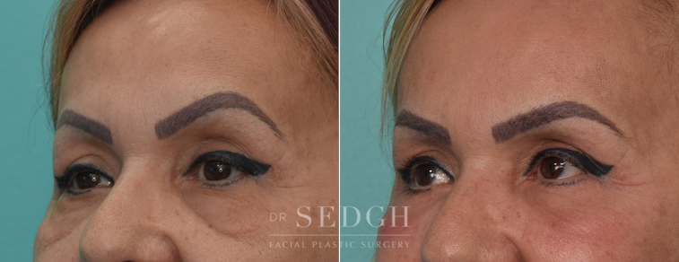 Lower Blepharoplasty Before and After | Sedgh