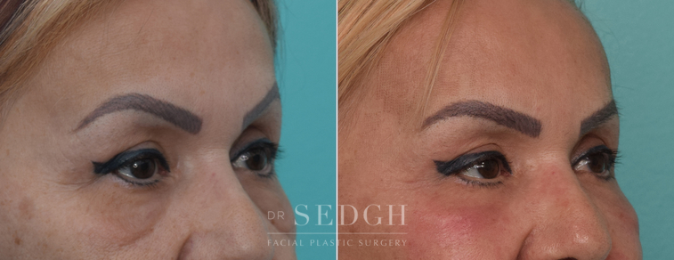 Lower Blepharoplasty Before and After | Sedgh