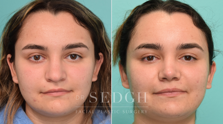 patient before and after rhinoplasty procedure