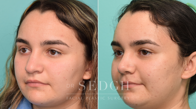 patient before and after rhinoplasty procedure