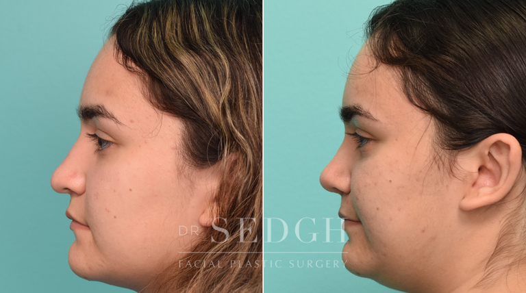 patient before and after rhinoplasty procedure