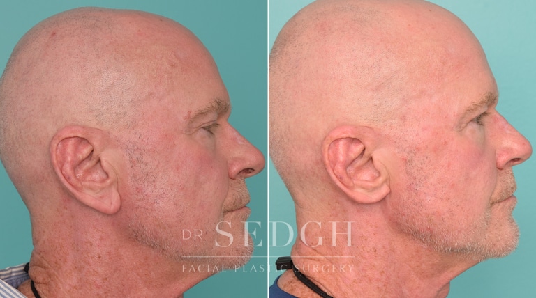 male patient before and after ear lobe reduction procedure