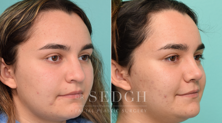 patient before and after rhinoplasty procedure